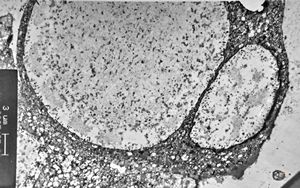 M,62y. | urinary bladder - cystitis cystica